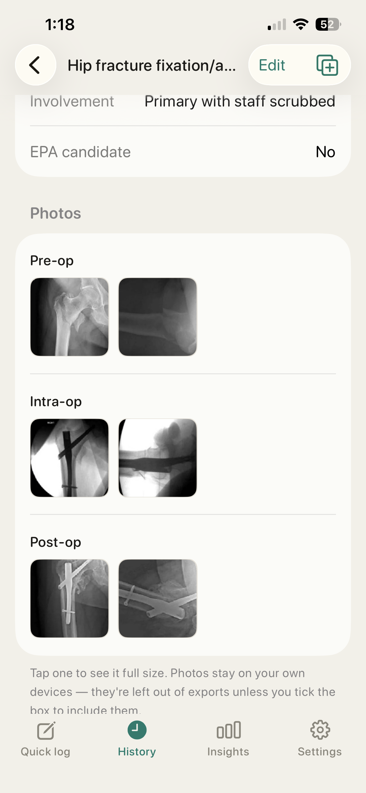 OrthoLog case showing pre-op, intra-op and post-op X-rays